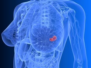 الورم الغدي الليفي في الغدة الثديية - العلاج بالعلاجات الشعبية بدون جراحة.  مراجعات الورم الغدي الليفي.