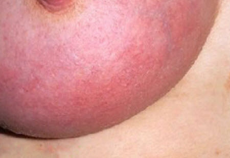授乳中の母親の胸が痛い場合。 授乳中の母親の乳房炎と乳汁うっ滞 - 症状と治療